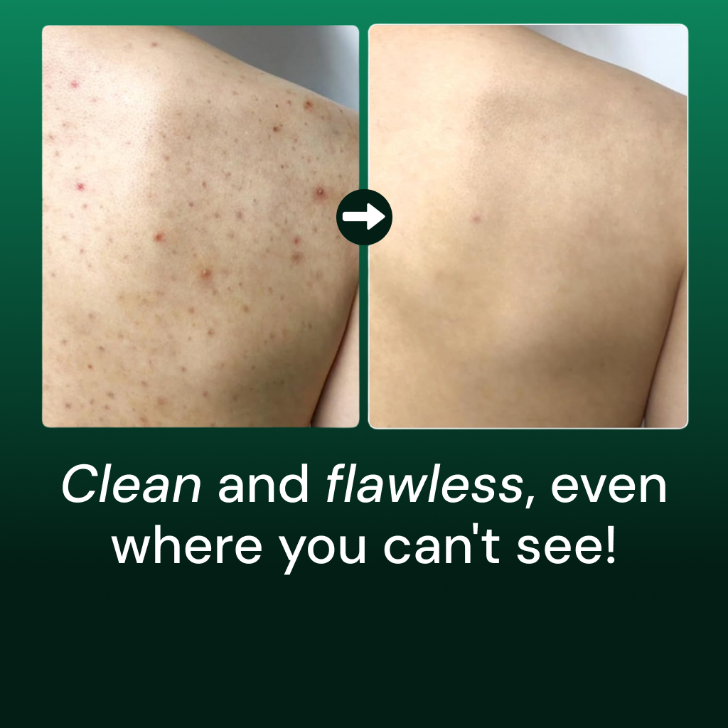 Acne Clear Body Cleanser